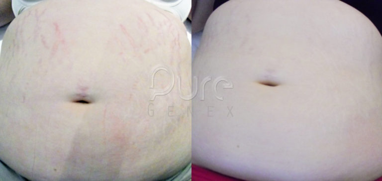 stretch-mark-reduction-before-and-after-1